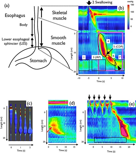 Mathematical model recreates muscle movements to explain swallowing disorders