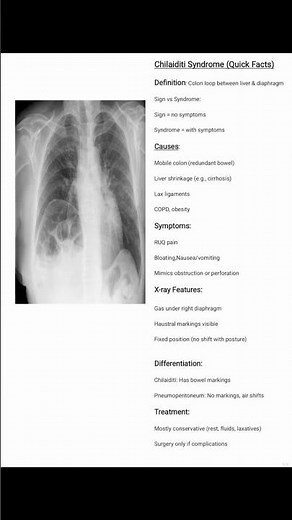 General Surgical Abdominal X-ray Series #Chilaiditi Syndrome #shortsfeed