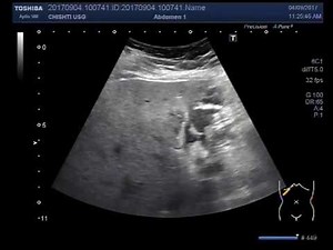 Ultrasound Video showing worm ( Ascaris lumbricoides ) in the gall bladder. Rare case.