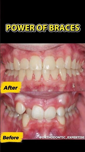Power of Braces 😮 Before & After
