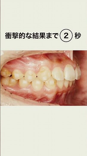 ワイヤーではなくマウスピース矯正したい方必見！#インビザライン #歯列矯正 #さいとう矯正歯科