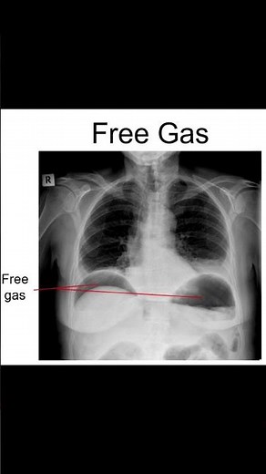 Don't Lose Marks - Free Air Under the Diaphragms on a Chest X-ray