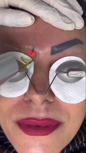 Remove eyebrow tattoo instantly with this 6 section will remove it completely