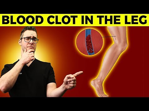 Blood Clot in the Leg? [ Early signs, Symptoms, How to Check & Causes]