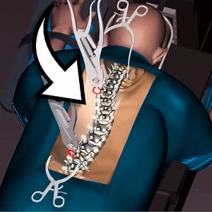 Fixing a curved Spine Credit http://www.teebpedia.com/ | R Crafts