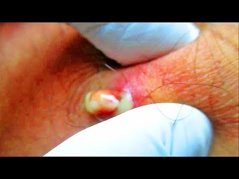 How To Get Rid of Boils on Inner Thigh