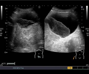 血尿が出た。膀胱腫瘍のエコー像 - らぴゅたった