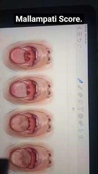 Mallampati Score. #neetpg #shorts
