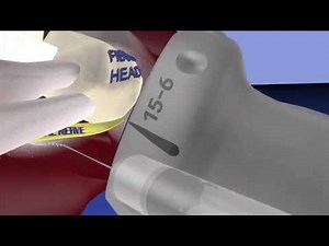 Ultrasound of common peroneal nerve hydrodissection... from probeultrasound.com