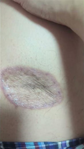 2/24 Today's rare cancer malignant melanoma and Opdivo side effects (´・ω・`)