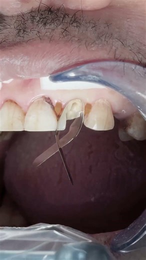 Composite restoration with fiber post to badly damaged anterior lateral tooth 🦷