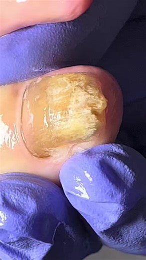 2.8K views · 21 reactions | Fixing Long Toenails with Fungus and Fungus Removal Process F921 #cleaner #longtoenails #toenails #nail #cleannail Disclaimer: This video is for educational and relaxation purposes only. All content belongs to the respective owners, and no copyright infringement is intended. | Care ASMR | Facebook