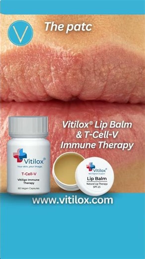 Vitiligo Eye Treatment – Case Study