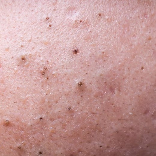 Dr. Pimple Popper's 25 Most Satisfying Blackhead Videos