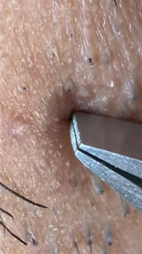 Hair plucking on face