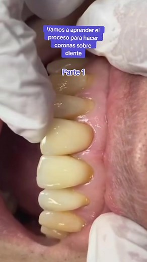 Proceso de Colocación de Coronas Dentales