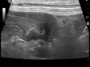ultrasonography of colonic torsion in a dog