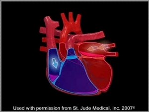 Life Line Screening - A-Fib and Stroke Animation