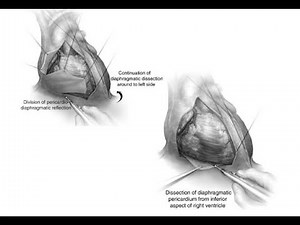 Pericardiectomy; part or all of the pericardium fibrous sac surrounding heart is removed