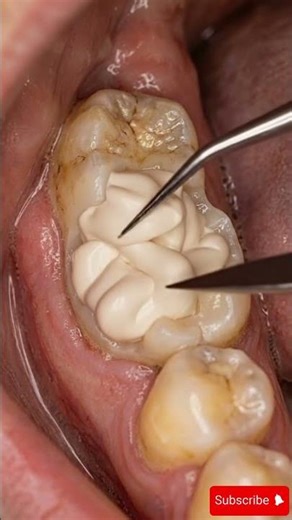 From Rotten to Perfect Tooth – Amazing Transformation #TeethFix #dentist #teethdecay #dentalasmr