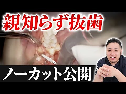 [Wisdom tooth extraction] We will show you all the steps of the dentist's surgery.
