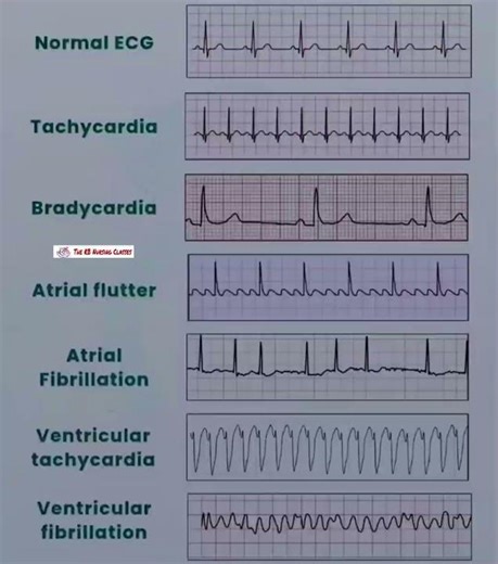 ECG (electrocardiograms)#nursingstudents #humanbody #ecg