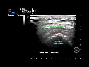ULTRASOUND AND GREATER TROCHANTER PAIN SYNDROME