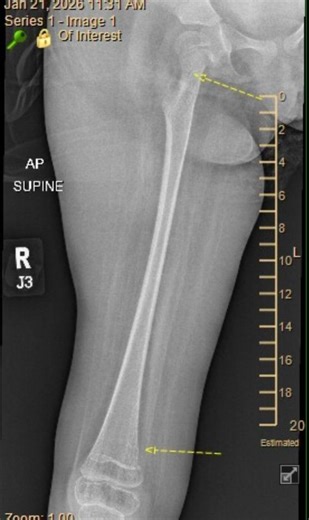 Mary | Update on Miss Emma. Today we had more detailed scans and xrays to view both of Emma's legs. Scans showed a buckle fracture of the right... | Instagram