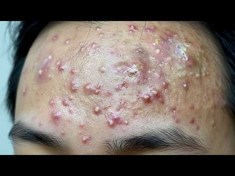 Deeply Satisfying Cyst Extractions for Stress Relief (No Talking)