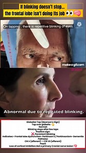 Why Won’t the Blinking Stop? 👀🧠 | Glabellar Tap Sign 🎥 Glabellar Tap Sign (Myerson’s Sign) Repetitive tapping over the glabella normally causes blinking that habituates after a few taps. ❌ Abnormal (Positive Sign): ➡️ Persistent, non-habituating blinking 🧠 What does it indicate? ✔️ Frontal lobe dysfunction (frontal release) ✔️ Parkinson’s disease / Parkinsonism ✔️ Dementia & other neurodegenerative disorders 🔍 Mechanism: • Afferent: Trigeminal nerve (CN V) • Efferent: Facial nerve (CN VII) 