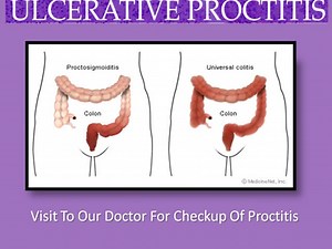 Ulcerative Proctitis Diet