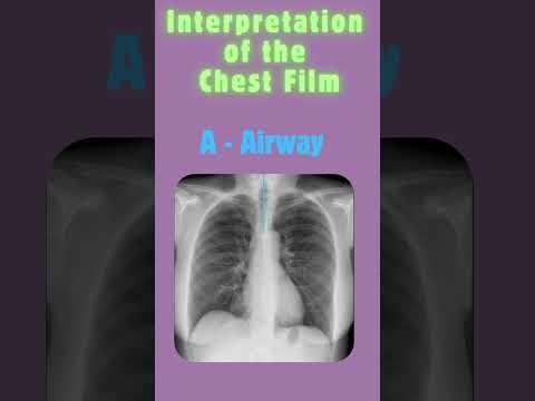 Chest X-Ray Interpretation Made Easy