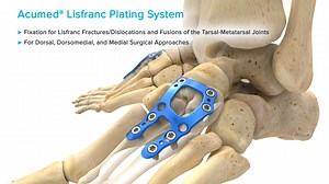 FNA90-64-A Lisfranc System Overview Animation