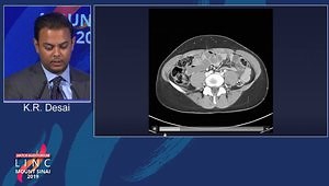 How I Do It: Deep Vein Thrombectomy