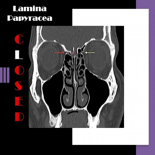 Nose radiology series (9): The lamina papyracea (5) #shorts