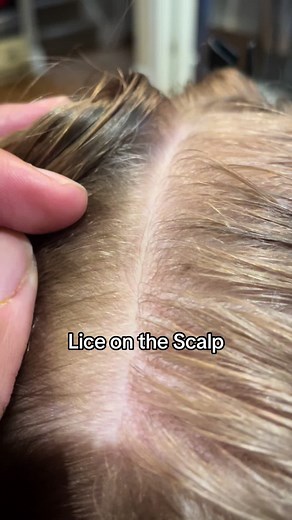 Adult Lice on the Scalp: What to Look For