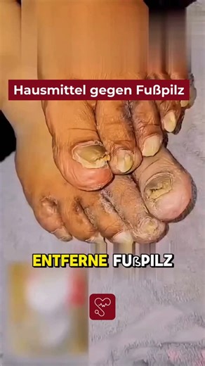 Gesundheits Fakten im Überblick on Instagram: "https://bit.ly/3N3EZpm 🦶✨ Unangenehmer Fußgeruch & Pilzprobleme natürlich angehen Ein einfaches Hausmittel, das viele überrascht – günstig, leicht gemacht & alltagstauglich. 🌿 So bereitest du es zu: 1️⃣ 3 EL mildes Shampoo in eine Schüssel geben 2️⃣ 1 EL Natron untermischen 3️⃣ Den Saft einer halben Zitrone hinzufügen Diese Kombination kann reinigend wirken und das Hautmilieu verändern. Mit Wattepad oder Pinsel auf die betroffenen Stellen auftrage