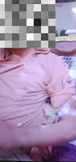 psychogenic non epileptic seizures (PNES) | Conversion disorder | Functional seizures