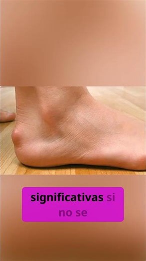 #Exostosis de #Haglund #pie #podologia #doctorfernandopifarre