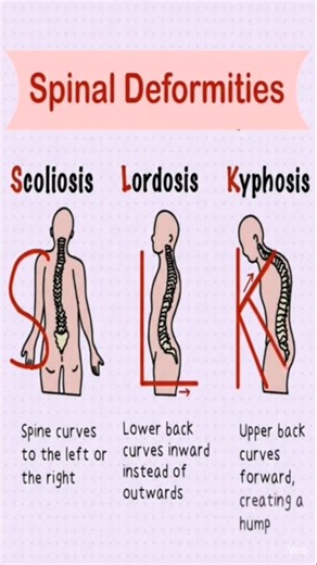 Kyphosis ll Spinal column Deformity ll