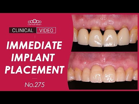 #11, 21 immediate implant placement after extraction [Dr. Cho Yongseok]