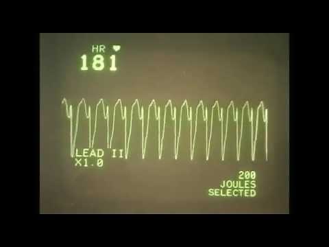 EKG (ECG) rhythms 2, Rhythms in cardiac arrest.