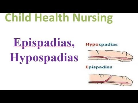 CHN: Epispadias and Hypospadias #studywithrakcha #medicalstudent #nursingnotes
