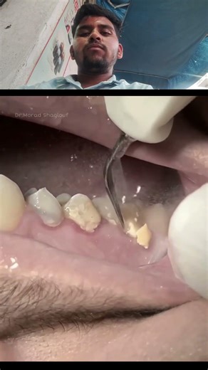 Scaling and cleaning tartar and calculus of teeth #satisfying