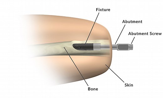 Transfemoral (above-knee) Amputations