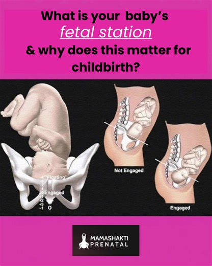What is fetal station and why does it matter for labor? Fetal station describes how far your baby has descended into your pelvis. In simple terms, it tells us whether baby is still “high” or has begun to engage, nestling deeper into the pelvic bowl in preparation for birth. When baby engages, their head (or presenting part) applies steady pressure to the cervix. This pressure helps the cervix soften, thin, and open supporting a smoother, more efficient labor. Many women notice that once baby is 