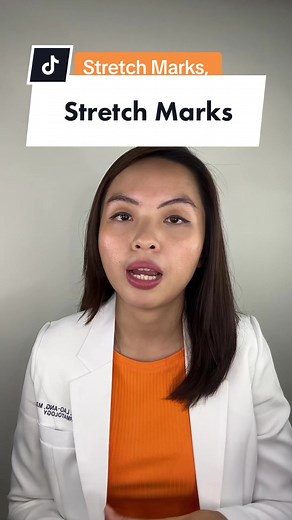 Paano Mawala ang Stretch Marks: Solusyon at Tips