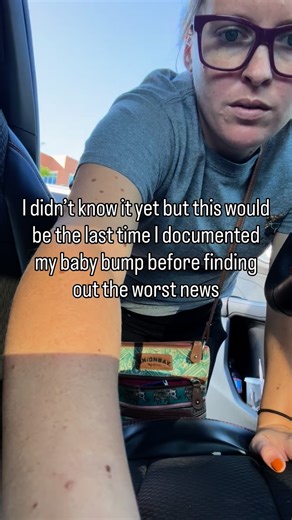 Hannah on Instagram: "A normal OB visit The week before I had gotten an amniocentesis with MFM but the microarray came back perfect I was starting to breathe easier again SIKE 🫠 A week or so later the full sequencing came back VERY bad Too much to write out but… lots of scary genetic anomalies. Very much the worse case scenario for a very wanted baby Adding another layer. I’m a surrogate. Not even MINE to keep. Lots and lots of emotions from everyone involved It’s a very surreal, feeling to go 