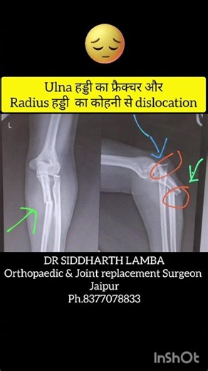 MONTEGGIA fracture# Radius हड्डी का कोहनी से dislocation# सफल सर्जरी #खुश मरीज 😊