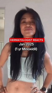Minoxidil for hair growth? How does it work? as a dermatologist I talk about topical minoxidil 5% foam daily with my patients. It is thought to help: ✅increase blood flow to hair follicles ✅reactivate weakened or dormant follicles ✅extend the hair growth (anagen) phase ✅support thicker, fuller-looking hair over time It’s important to note: ❌avoid in pregnancy ❌avoid around pets ✅best results with consistent daily use ✅foam tends to be less irritating to th scalp than the solution What questions 